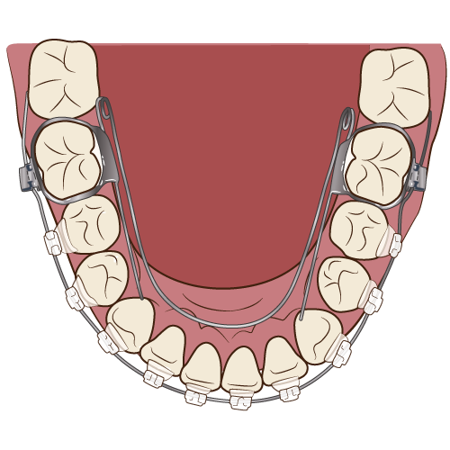 リンガルアーチ
