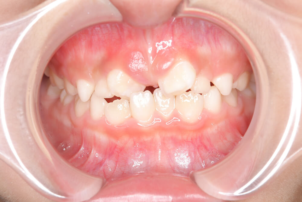 叢生 正面 before