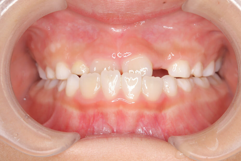 受け口（反対咬合） 正面 before