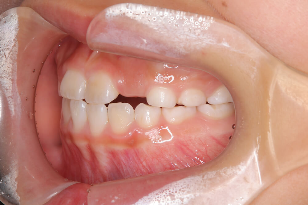 受け口（反対咬合） 左面 after