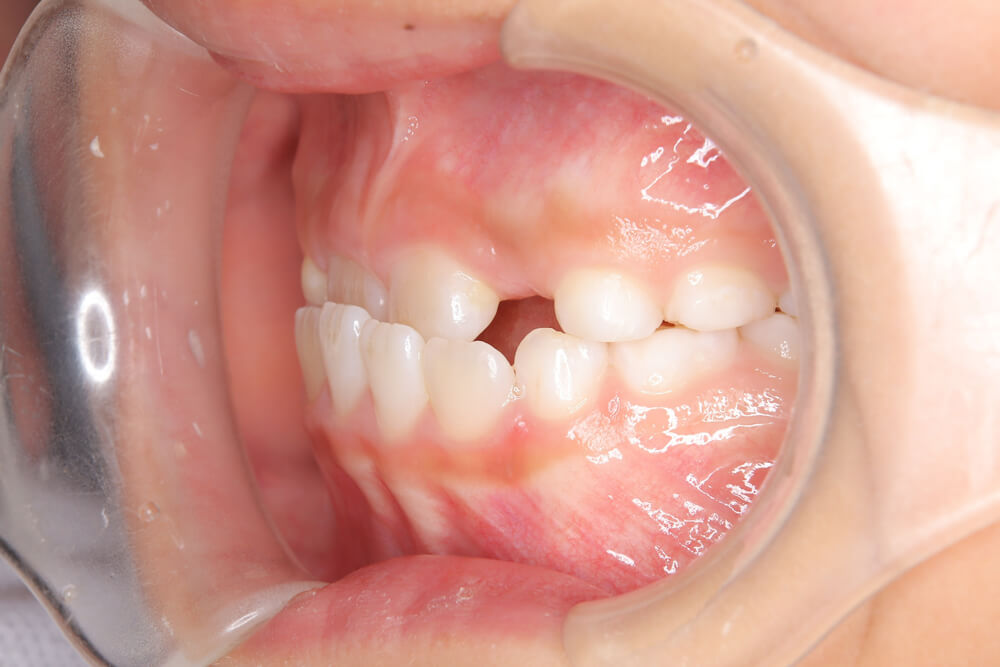 受け口（反対咬合） 左面 before