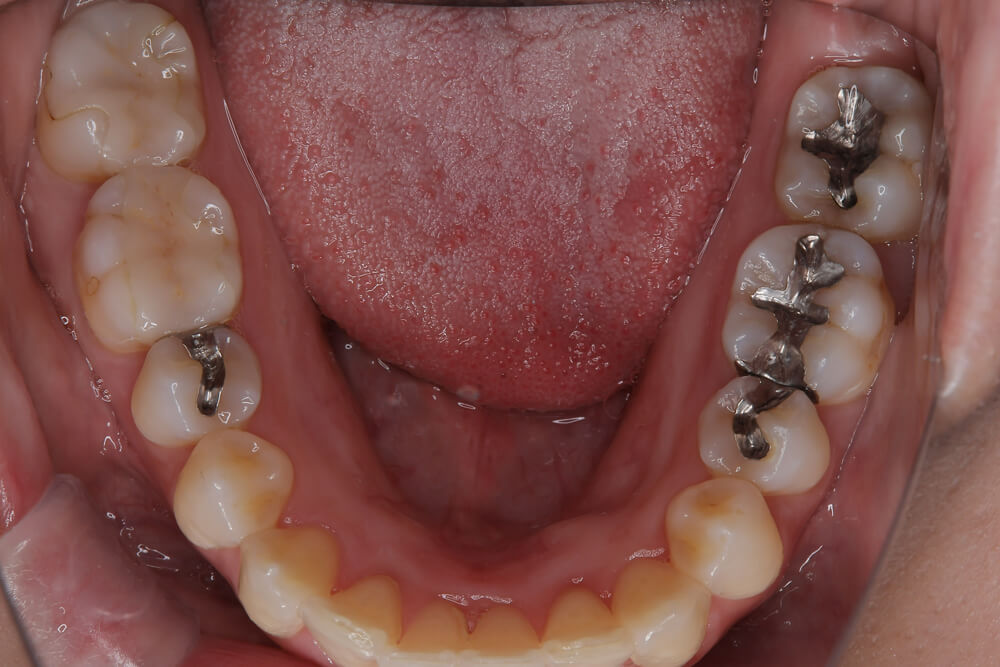 前歯のガタつき・非抜歯・欠損あり マウスピース矯正 下顎 after