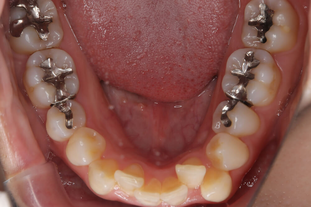 前歯のガタつき・非抜歯・欠損あり マウスピース矯正 下顎 before