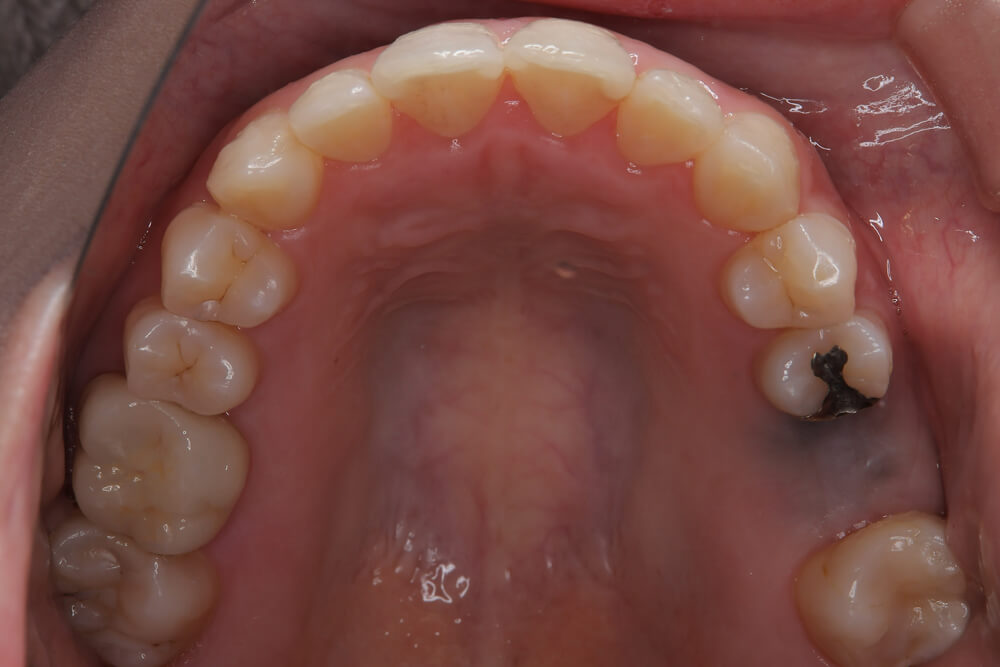 前歯のガタつき・非抜歯・欠損あり マウスピース矯正 上顎 after