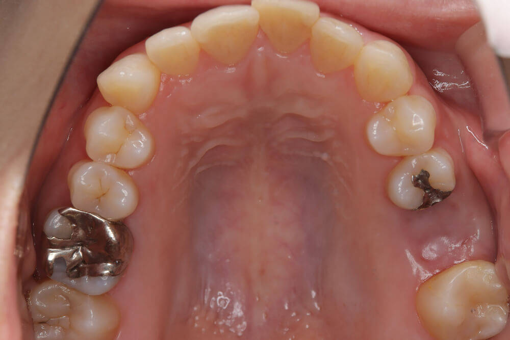 前歯のガタつき・非抜歯・欠損あり マウスピース矯正 上顎 before